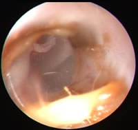 Videootoskopie: Darstellung des Trommelfells in einem gesunden Ohr