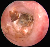 Videootoskopie bei Otitis externa: der Gehörgang ist gerötet und das Trommelfell ist wegen des braunen Ohrsekrets nicht sichtbar