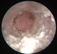 Videootoskopie: Darstellung eines Polypen im Gehörgang einer Katze